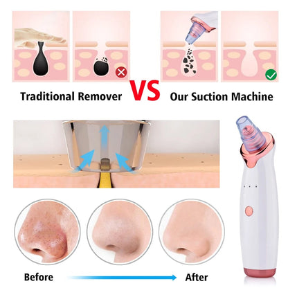 Original 5-in-1 Blackhead remover ❤️With Rechargeable 🔋