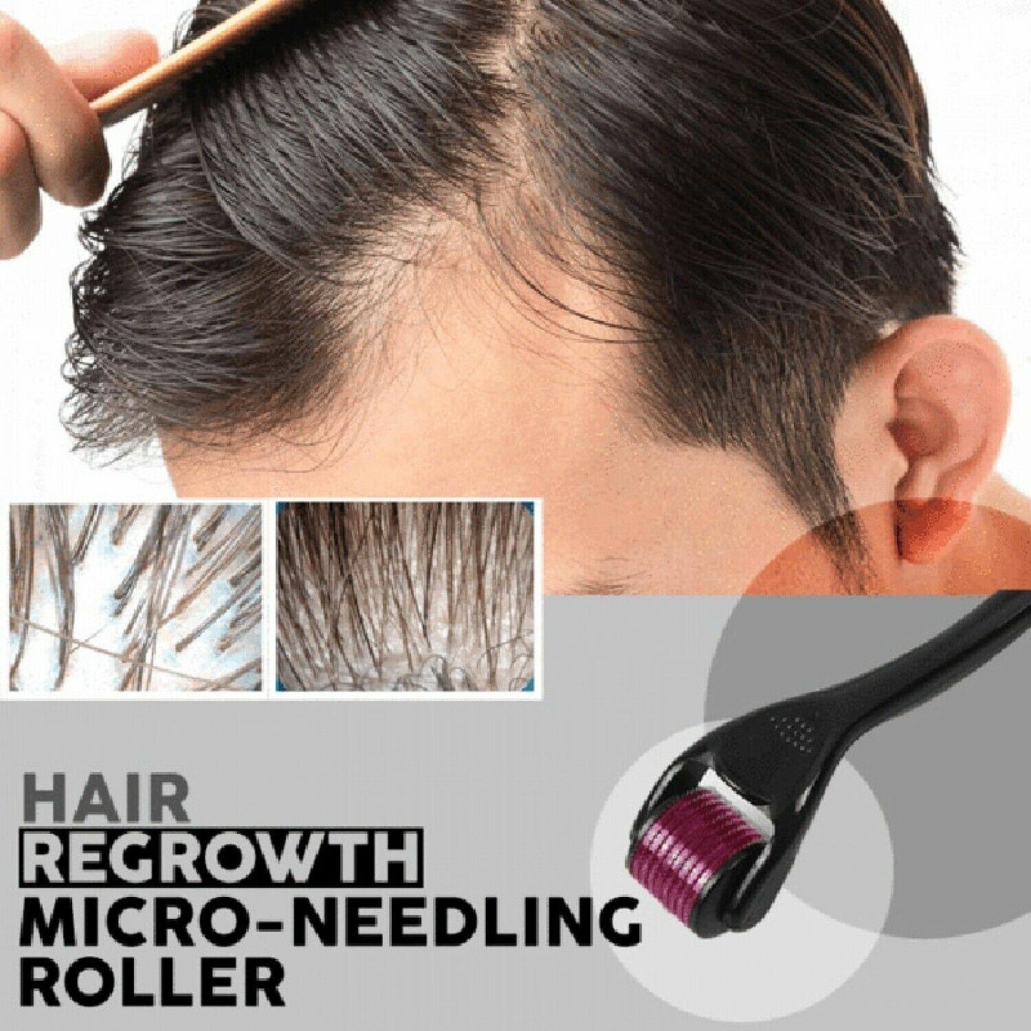 Derma Roller 0.5mm With 540 Micro Needle For Hair Growth 🔥🕛